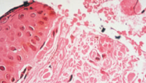 金属メスによる挫滅した切開創"