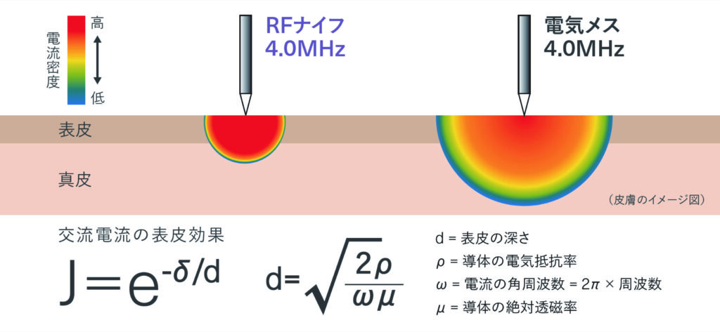 4.0MHz/1.7MHzによる表皮効果で実現する効率的な切開・凝固