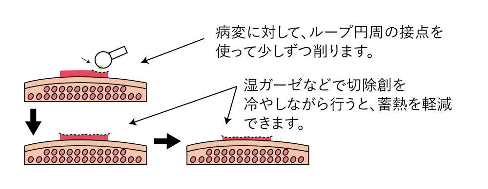 ラウンド型ループ