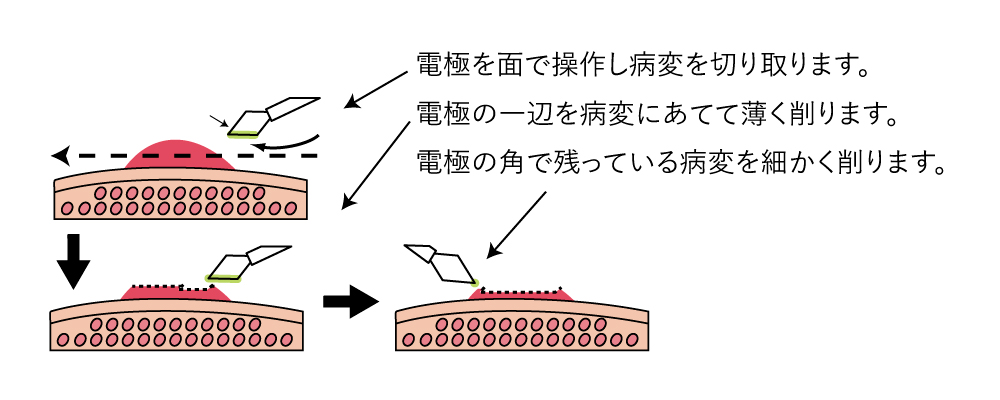 ラウンド型ループ